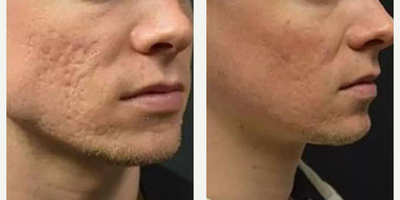 Woman treated with Infini RF - Woman treated with Infini RF
