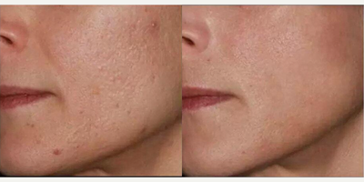 Woman treated with Infini RF - Woman treated with Infini RF