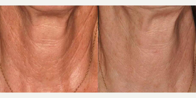 Woman treated with Infini RF - Woman treated with Infini RF