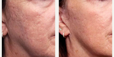 Woman treated with Infini RF - Woman treated with Infini RF