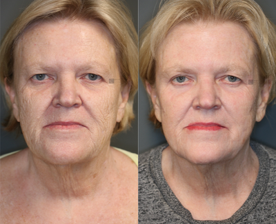 Pulsed Dye Laser - Laser and fat based stem cell treatment to face.