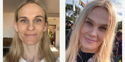35-44 year old woman treated with Brow Lift, Rhinoplasty, Jaw Reduction - The patient had a bulbous nose, hollow eyes and wide chin. The patient wanted to have a smaller nose tip, a younger look around the eyes and a smaller chin. Therefore she had a jaw reduction, temporal lift and rhinoplasty surgery. This is one month after her combined face surgery.