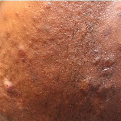 keloid vs hypertrophic scar