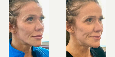 Woman treated with Voluma, Juvederm, Lip Fillers - This shows the patient after receiving Voluma to her cheeks, Volux in the jawline & Ultra to her lips.