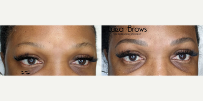 Woman treated with Microblading - Woman treated with Microblading