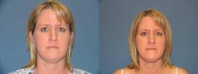 Aqualipo - Aqualipo is a minimally invasive way to remove unwanted fat and to sculpt areas of the body. Naturalfill procedure was performed to inject patients own fat into her face for additional volume.