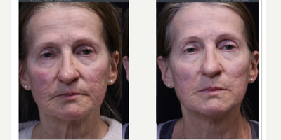 65-74 year old woman treated with Laser Scar Removal, Fractional Laser, Laser Resurfacing, CO2 Laser - Lasercoring with ultraclear laser for scars 3 months, note this patient has never had any treatments before. Lasercoring, is a nonsurgical laser-enabled fractional tissue coring and laser-induced deep dermal collagen remodeling resulting in total transformation.