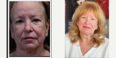 65-74 year old woman treated with Laser Resurfacing, Fractional Laser - Lasercoring with ultraclear laser for full face and full neck one session after 3 months, note this patient has never had any treatments before. Lasercoring, is a nonsurgical laser-enabled fractional tissue coring and laser-induced deep dermal collagen remodeling resulting in total transformation.