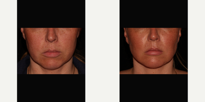 Buccal Fat Pad Removal with Neck Liposuction - Buccal Fat Pad Removal can be done under local anesthesia or sedation.