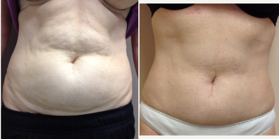 55-64 year old woman treated with Liposonix - Patient had one single treatment with liposonix. 3 passes over entire abdomen. There was only mild bruising afterwards and no significant discomfort after the procedure. The patient has noticed marked improvement in permanent fat loss and improvement in skin quality.