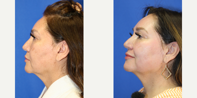 55-64 year old woman treated with Chemical Peel - This is a 57 year old Hispanic patient who was not happy with the uneven skin coloring, fine lines, and dark spots in her face. She had a chemical peel with Dr. J. Timothy Katzen in Beverly Hills, CA.  Notice the improvement in her skin, improved fine lines and dark spots.