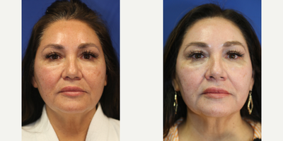 55-64 year old woman treated with Chemical Peel - This is a 57 year old Hispanic patient who was not happy with the uneven skin coloring, fine lines, and dark spots in her face. She had a chemical peel with Dr. J. Timothy Katzen in Beverly Hills, CA.  Notice the improvement in her skin, improved fine lines and dark spots.