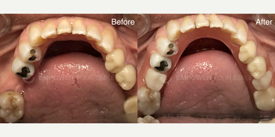 75 and up year old woman treated with Tooth Repair - 75 and up year old woman treated with Removable Partial