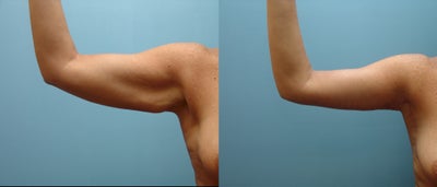 47 Year Old Female Treated for Excess Arm Skin - 
	Brachioplasty (Arm Lift) performed with hidden scar approach. At 3 months.
