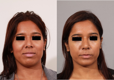 27 year old female who underwent a revision rhinoplasty and chin implant. - This patient had a previous rhinoplasty and wanted improvement in the hump on her nose. She was also bothered by the flaring of her nostrils while smiling. She had a small hump reduction, alar base reduction, tip narrowing, and chin implant placed.