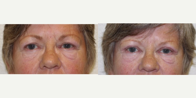 Upper Eyelid Surgery - Age 65-74 - Upper eyelid blepharoplasty. She had significant hanging skin over her upper eyelids and lashes, more so on her right side. She now has a crisp upper eyelid fold.