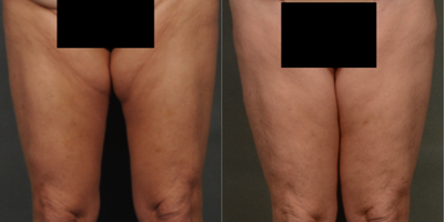 55-64 year old woman treated with Thigh Lift - Thigh Lift (groin).