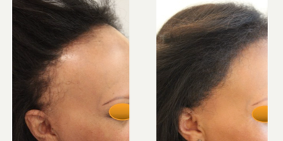 Female African-American Hairline Advancement (1935 FUT grafts): Carlos K. Wesley, M.D. (NYC & LA) - This 53-year-old woman underwent a follicular unit transplantation (]FUT) session with Dr. Carlos K. Wesley in which a total of 1935 grafts were placed.Aspects of our surgical approach can be viewed on our sites Most Common Questions page. Three unique elements combined to help improve her experience: methods for optimal discretion, enhanced graft storage measures, and rigid patient safety standards.As with all of Dr. Wesleys patients, she was NOT required to trim her hair for the procedure. As a result, this patient was able to return comfortably to work and social activities within approximately 7-10 days of her procedure.Her hair follicles were incubated in autologous (her own) platelet rich plasma (PRP) throughout the duration of the procedure. This, combined with an ATP-containing storage solution has been shown to enhance survival of transplanted hairs.Finally, having her procedure performed in our office with the highest standards of COVID precautions helped ensure patient safety. Every patient of Dr. Wesleys receives a rapid COVID test upon arrival to our office equipped with an ultraviolet air purification system. Measures such as reducing foot traffic by performing virtual consultations at no charge to patients, regular staff COVID testing and no-touch temperature checks of our team that avoids public transportation help preserve our clean and sanitary safe haven. Daily sterilization of the office coupled with the most rigid OR safety precautions further allay patient concerns in this sensitive time.The patient returned 18 months after her procedure and images of the patient can be seen below. This link illustrates the timing of hair growth after surgery. Similar patient hair transformations with Dr. Wesley and his team may also be viewed.