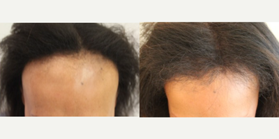 Female African-American Hairline Advancement (1935 FUT grafts): Carlos K. Wesley, M.D. (NYC & LA) - This 53-year-old woman underwent a follicular unit transplantation (]FUT) session with Dr. Carlos K. Wesley in which a total of 1935 grafts were placed.Aspects of our surgical approach can be viewed on our sites Most Common Questions page. Three unique elements combined to help improve her experience: methods for optimal discretion, enhanced graft storage measures, and rigid patient safety standards.As with all of Dr. Wesleys patients, she was NOT required to trim her hair for the procedure. As a result, this patient was able to return comfortably to work and social activities within approximately 7-10 days of her procedure.Her hair follicles were incubated in autologous (her own) platelet rich plasma (PRP) throughout the duration of the procedure. This, combined with an ATP-containing storage solution has been shown to enhance survival of transplanted hairs.Finally, having her procedure performed in our office with the highest standards of COVID precautions helped ensure patient safety. Every patient of Dr. Wesleys receives a rapid COVID test upon arrival to our office equipped with an ultraviolet air purification system. Measures such as reducing foot traffic by performing virtual consultations at no charge to patients, regular staff COVID testing and no-touch temperature checks of our team that avoids public transportation help preserve our clean and sanitary safe haven. Daily sterilization of the office coupled with the most rigid OR safety precautions further allay patient concerns in this sensitive time.The patient returned 18 months after her procedure and images of the patient can be seen below. This link illustrates the timing of hair growth after surgery. Similar patient hair transformations with Dr. Wesley and his team may also be viewed.