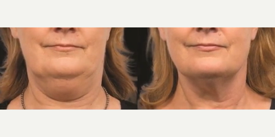 Woman treated with CoolSculpting - Coolsculpting has become one of the worlds leading non-invasive body contouring treatments that targets and freezes fat cells beneath the skin without harming the skin itself. Once the fat has been crystallized the body will naturally respond by gradually shrinking them and compresses the greater area. No downtime. No anesthesia. No needles.