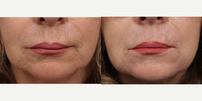 55-64 year old woman treated with Chemical Peel - Hetter Peel to Perioral Area