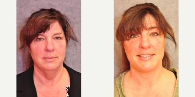 45 year old woman who hated her heavy neck - This athletic 45 y.o. woman felt her neck aged her. The fat was removed from her neck and jowls and the supporting midline muscles of the neck tightened. In addition the soft tissue of the cheeks was raised.