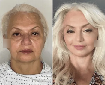 62 year old woman treated with Neck Lift, CO2 Laser - 62 year old female who underwent a Deep Plane Facelift, Extended Deep plane Neck Lift, Lower Blepharoplasty, and CO2 laser to face under local anesthesia with oral sedation.She is now 1 months out from the surgery with beautiful jawline and deep neck. Attached is comparison picture from 14 years prior to surgery.