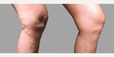 35-44 year old woman treated with VenaSeal - Chronic Venous Insufficiency (CVI) Treatment