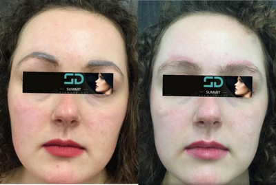 Woman treated with Enlighten - Woman treated with Enlighten Laser Tattoo Removal for eyebrows, shown 5 months post op.