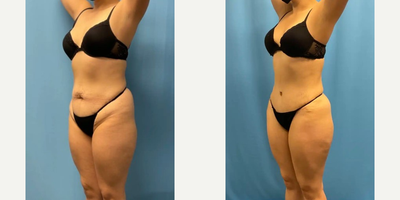 Woman treated with Tummy Tuck - Procedure: Abdominoplasty with Liposuction of the abdomen and flanks.