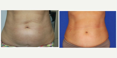 35-44 year old woman treated with Velashape - patient had velashape for skin tightening