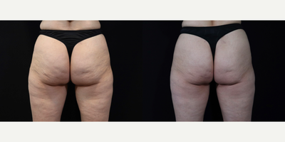 45-54 year old woman treated with Qwo & Resonic - Female Patient treated with Resonic Cellulite Treatment and limited QWO. Excellent results in reduction of dimpling.