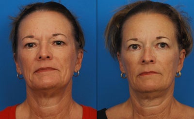 Ultherapy - 
	Ultherapy