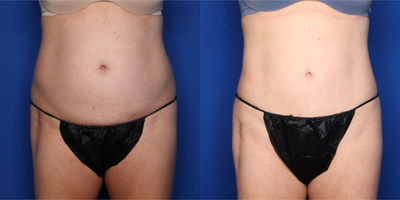 45-54 year old woman treated with BodyTite, Liposuction - 49 year old female shown 6 months after BodyTite lipo to abdomen and power assisted liposuction to her flanks with almost 2 L removed.