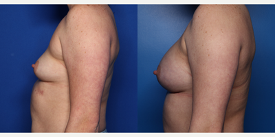 25-34 year old woman treated with Breast Implants, Breast Augmentation, Natrelle Breast Implants - 31 year old female shown 6 months after bilateral breast augmentation with 365 cc high profile silicone round smooth Natrelle Soft Touch silicone implants placed in a dual plane position through an inframammary crease incision.  She also had liposuction to her axillary (armpit) region.