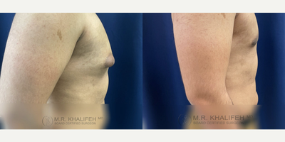 35-44 year old man treated with Gynecomastia Surgery - Gynecomastia in patient removed via awake procedure.
