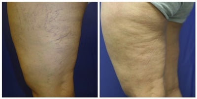 spider vein sclerotherapy with asclera - 
	sclero
