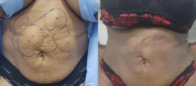 35-44 year old woman treated with Seroma Formation - Patient developed a large seroma and subsequent scarring after the Liposuction on the abdomen. This is her improvement after stage 1 of a 2-staged seroma revision surgery. the patient is continuing to improve