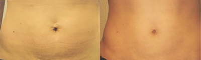 45-54 year old woman treated with Titan - Patient treated with four Titan treatments to tighten loose abdominal skin. Visible results after three treatments. Collagen reformulation continues for about 9 months.