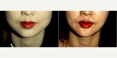 35-44 year old woman treated with Jaw Reduction - Asian woman who had jaw reduction