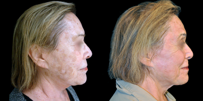 65-74 year old woman treated with ActiveFX - This patient underwent TotalFX laser resurfacing. The DeepFX laser handpiece was used to treat around the eyes and around the mouth. The ActiveFX laser handpiece was used to treat the entire face.