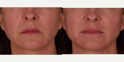 Correction to corners of the mouth and enhanced jawline definition  NovaThreads - This patient was looking for subtle changes to define her jawline and to minimize the jowls and lines present at the corners of her mouth. Results demonstrate before and immediate afters to the NovaLift procedure  a combination of the thread lift with dermal fillers. Novathreads provided our patient with facial tissue lifting as well as increased definition to the jawline. Restylane was added to the patients corner of mouth and pre-jowl regions. Results typically last anywhere from 6 months to a year.