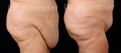 61 year old woman treated with Panniculectomy - 61 year old woman treated with Panniculectomy