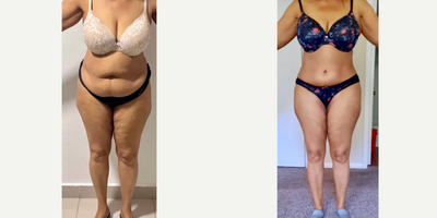 25-34 year old woman treated with Tummy Tuck, Liposuction, Brazilian Butt Lift - Excellent outcome after full tummy tuck combined with intense liposuction including abdomen, waist, laterals and upper and lower back to improve your body contour and get better curves, especially in your waist area and dominican butt lift.