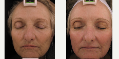 55-64 year old woman treated with CO2 Laser - Resurfacing with our CORE laser may be an effective way to improve the overall quality and appearance of your skin. With minimal downtime, our CO2 laser will reduce your wrinkles, scars, sun damage, age spots, or cutaneous lesions and will leave you loving your skin!Introducing the CO2RE Fractional CO2 Resurfacing System CO2RE is a fractional CO2 resurfacing laser treatment that simultaneously targets both the superficial and deep layers of the skin. CO2RE treatment is a lighter, faster and more versatile solution for improving skin tone and texture, sun-damage, and age spots.