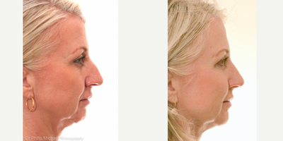 35-44 year old woman treated with Rhinoplasty - 35-44 year old woman treated with Rhinoplasty