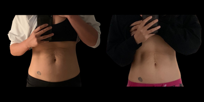 35-44 year old woman treated with Evolve - Trim + Tite