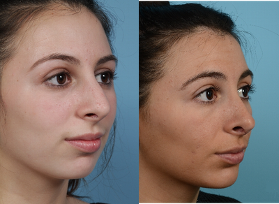 Patient treated with Rhinoplasty - Patient treated with Rhinoplasty