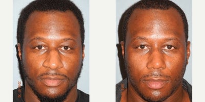 Man treated with African American Rhinoplasty - Man treated with African American Rhinoplasty