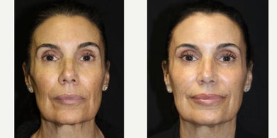 55-64 year old woman treated with Sculptra - 55-64 year old treated with Sculptra